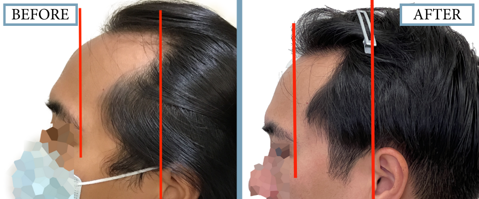 THTS Before and After FUE