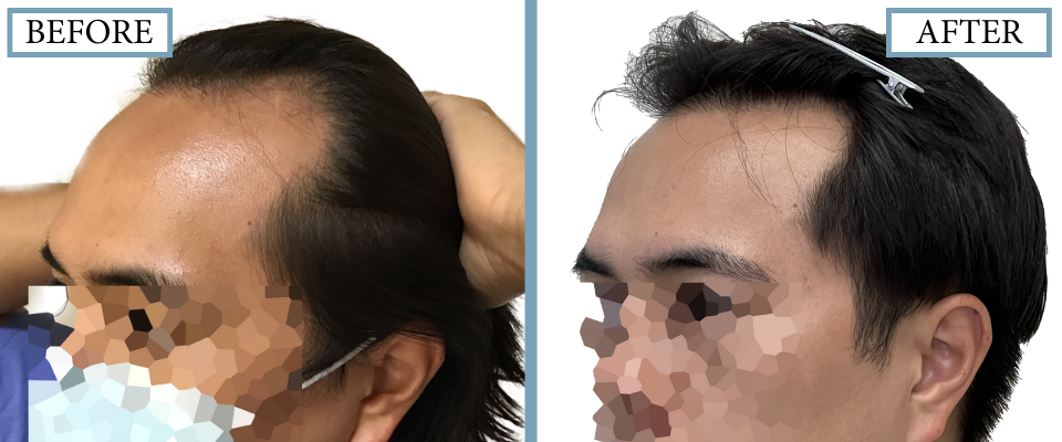 THTS Before and After FUE
