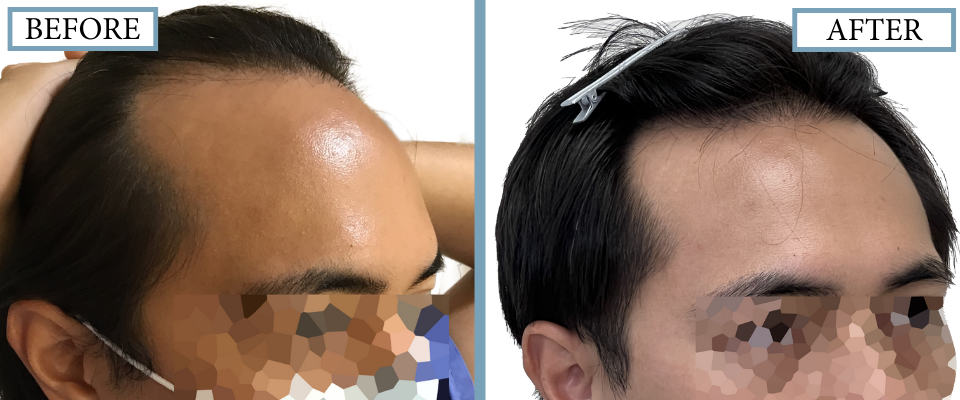 THTS Before and After FUE