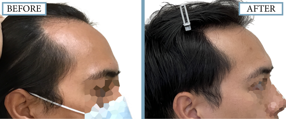 THTS Before and After FUE