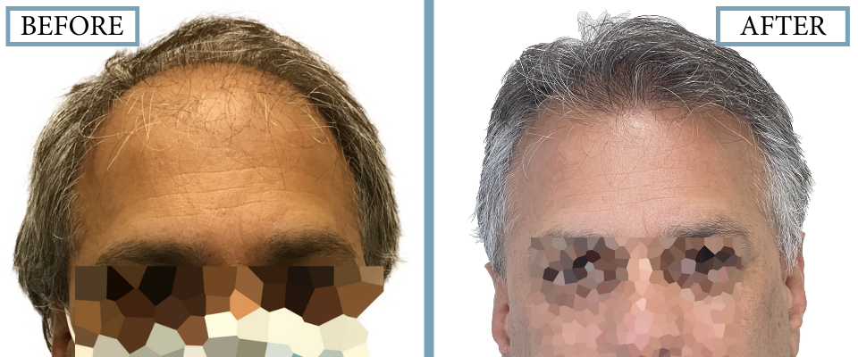 THTS Before and After FUT/Strip