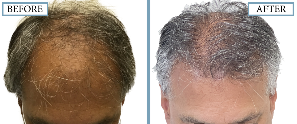 THTS Before and After FUT/Strip