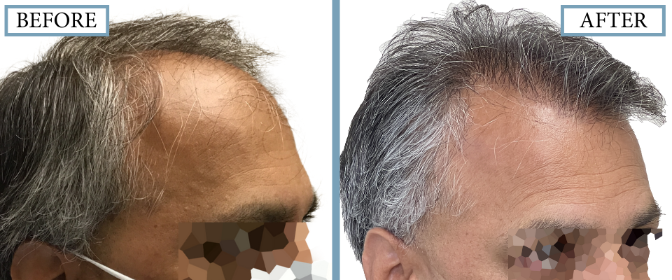 THTS Before and After FUT/Strip