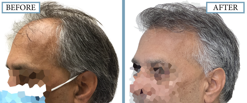 THTS Before and After FUT/Strip