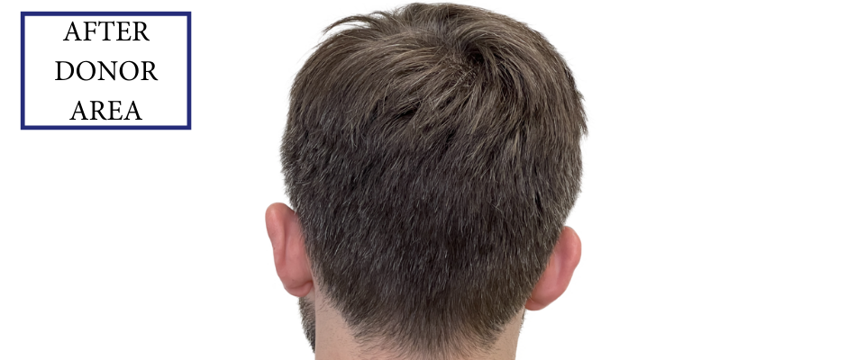 THTS Before and After FUE