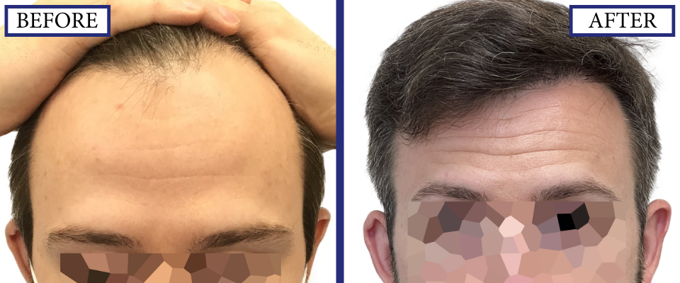 THTS Before and After FUE