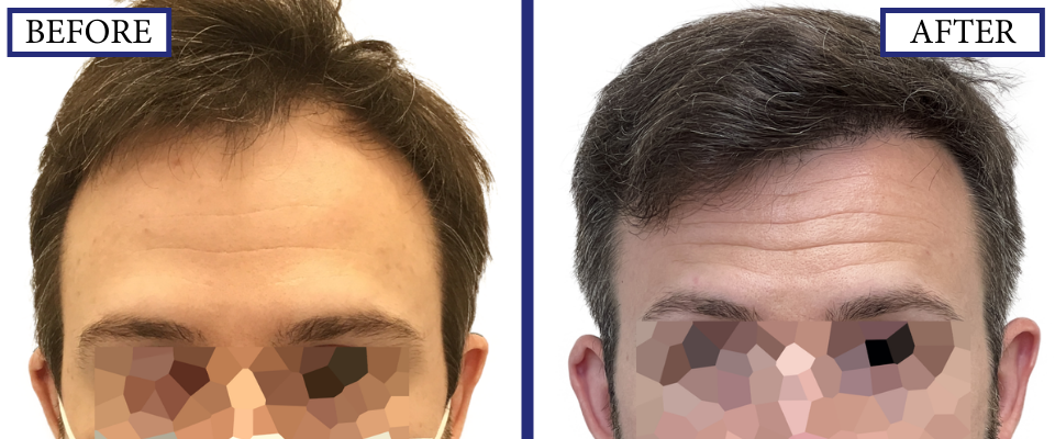 THTS Before and After FUE