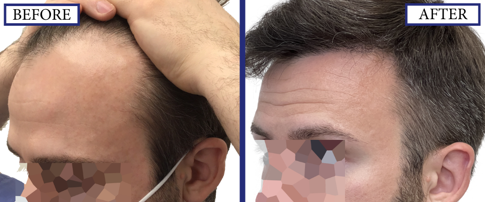 THTS Before and After FUE