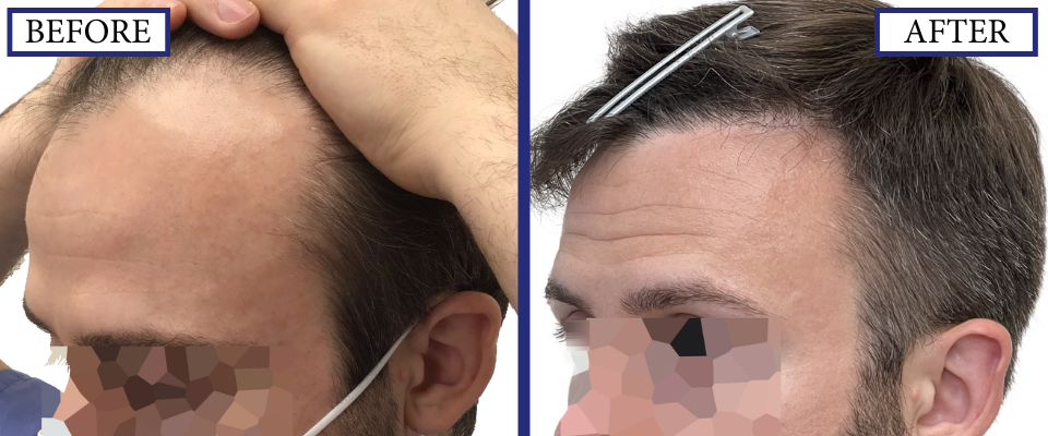 THTS Before and After FUE