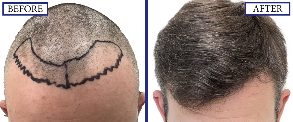 THTS Before and After FUE