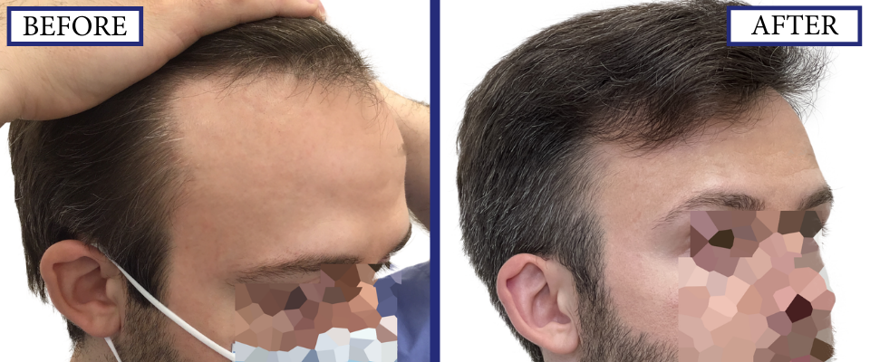 THTS Before and After FUE