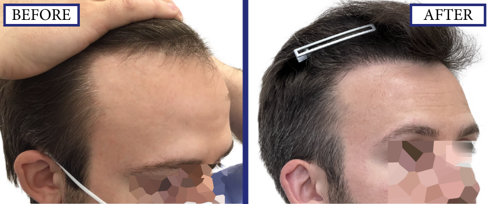 THTS Before and After FUE