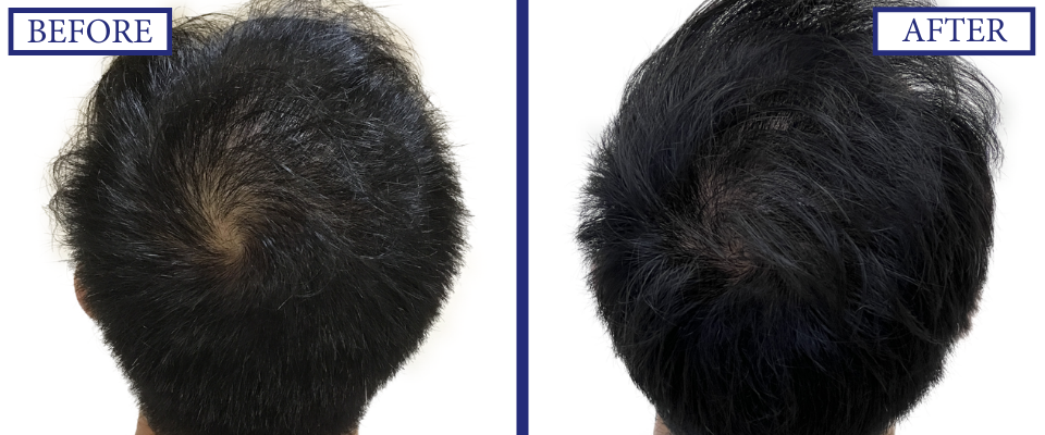 THTS Before and After FUE