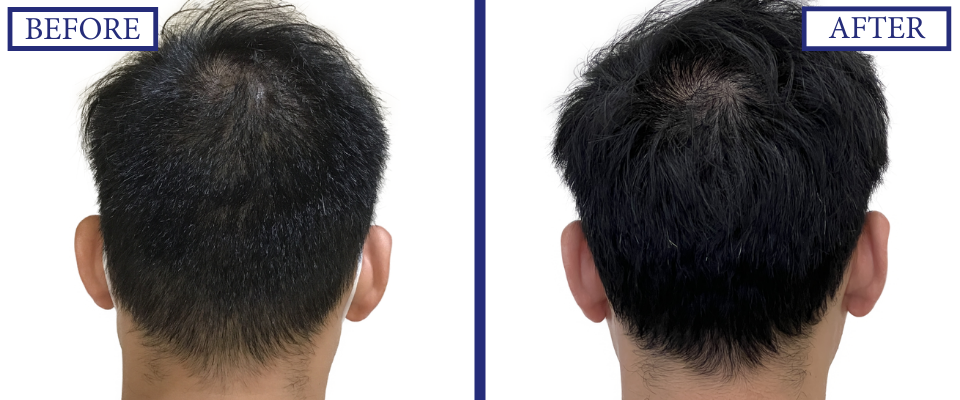 THTS Before and After FUE