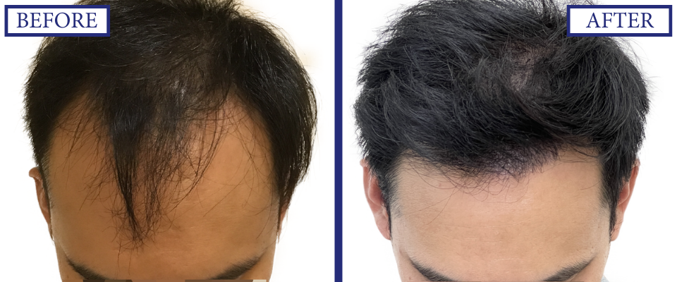 THTS Before and After FUE