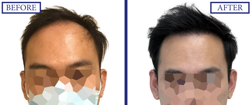 THTS Before and After FUE