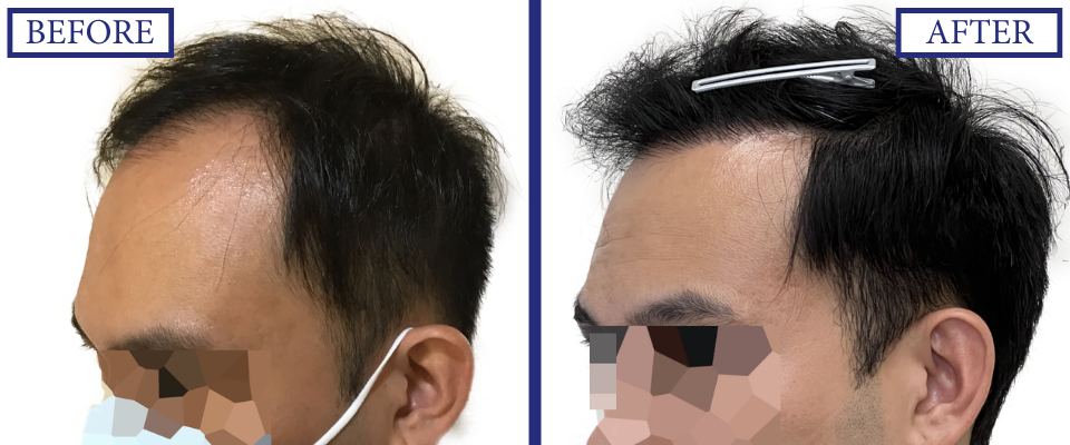 THTS Before and After FUE