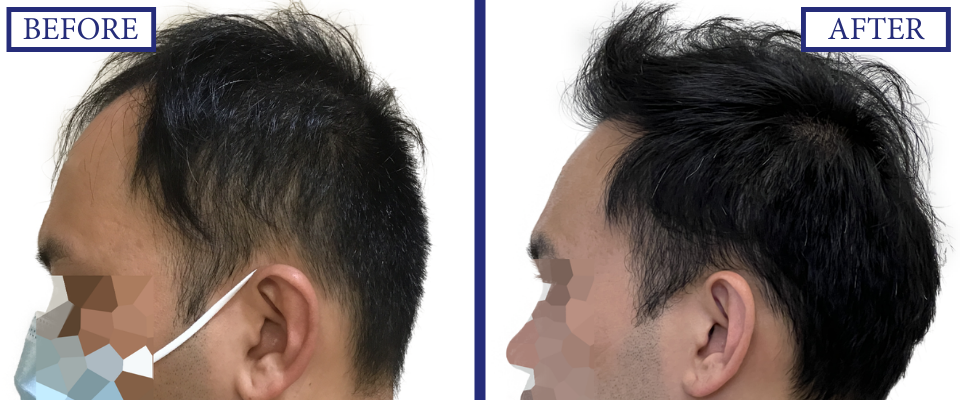 THTS Before and After FUE