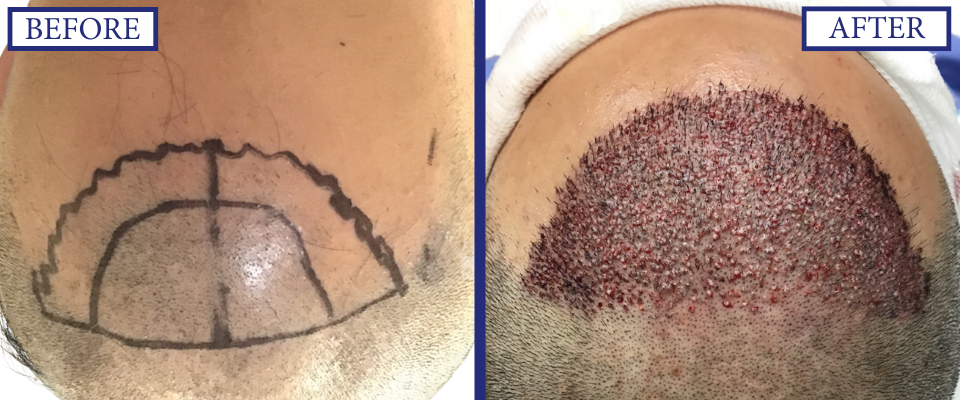 THTS Before and After FUE