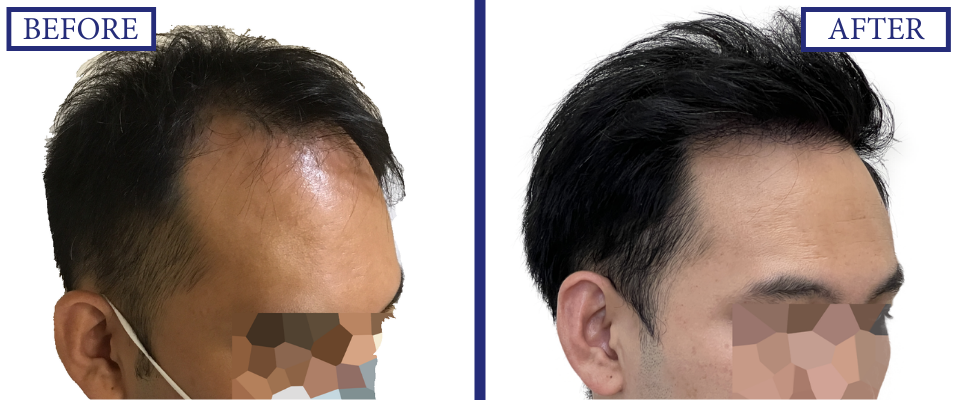 THTS Before and After FUE