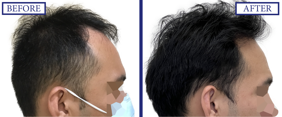 THTS Before and After FUE