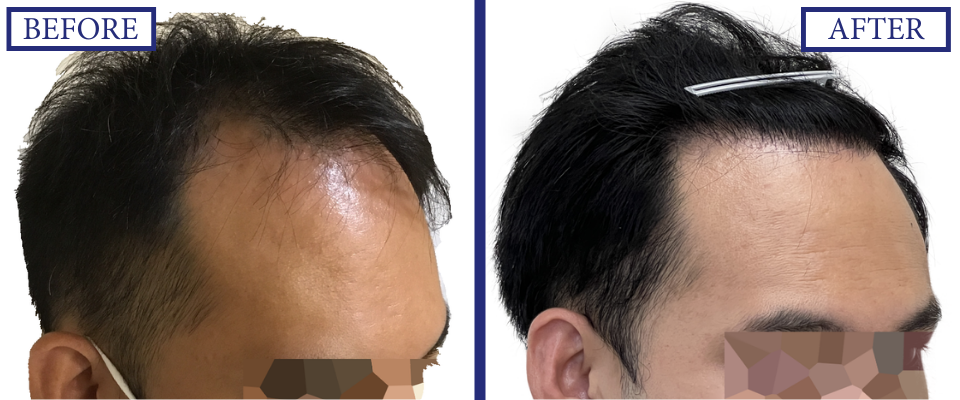THTS Before and After FUE