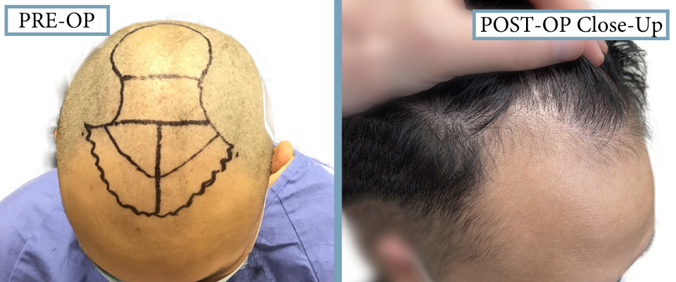 3146 Graft FUE