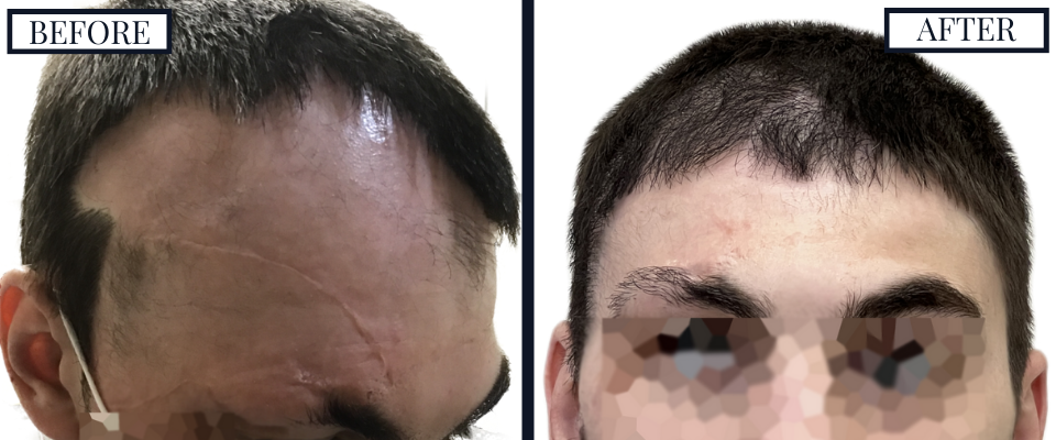 THTS SCAR REVISION