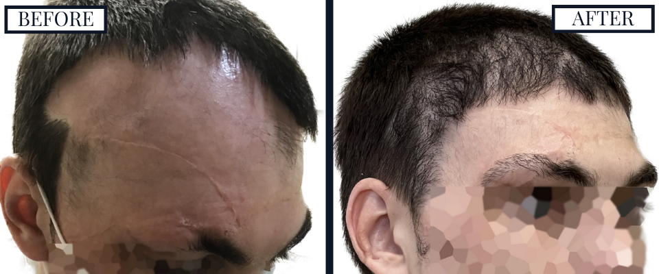THTS SCAR REVISION