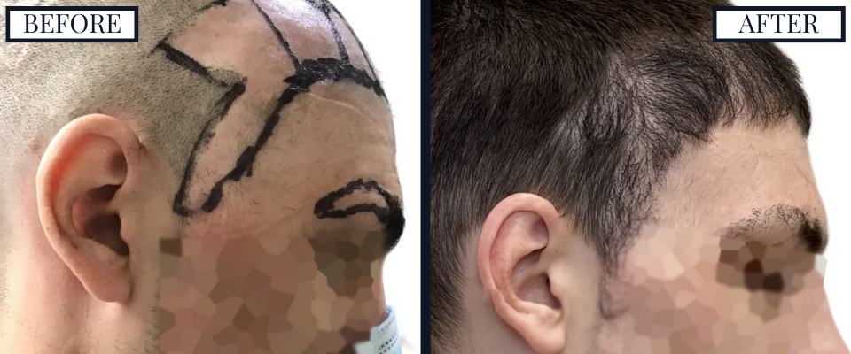 THTS SCAR REVISION