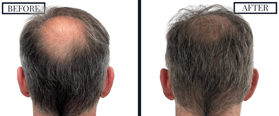 2050 FUE GRAFT HAIR TRANSPLANT