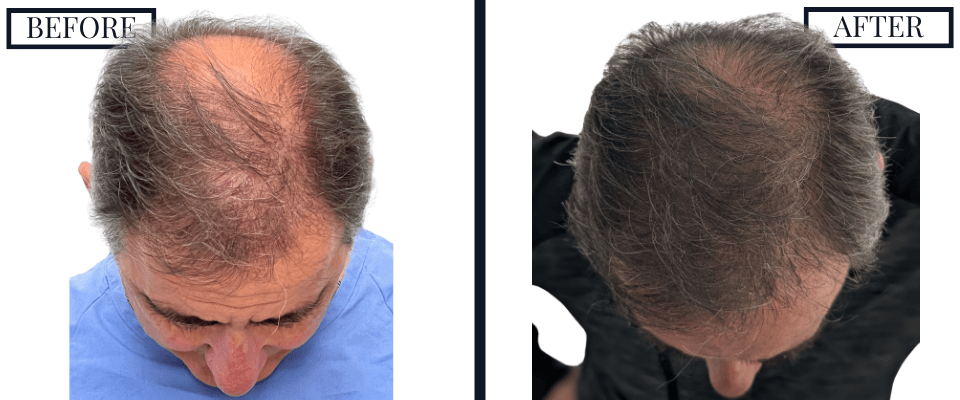 2050 FUE GRAFT HAIR TRANSPLANT