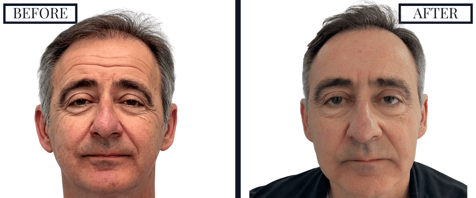 2050 FUE GRAFT HAIR TRANSPLANT
