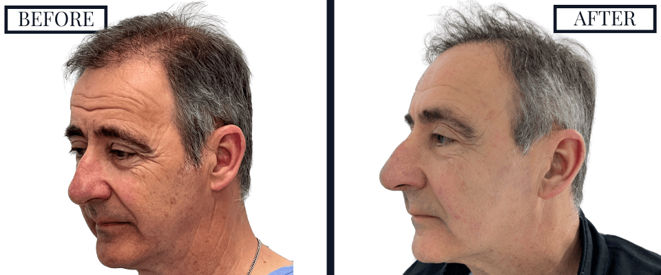 2050 FUE GRAFT HAIR TRANSPLANT