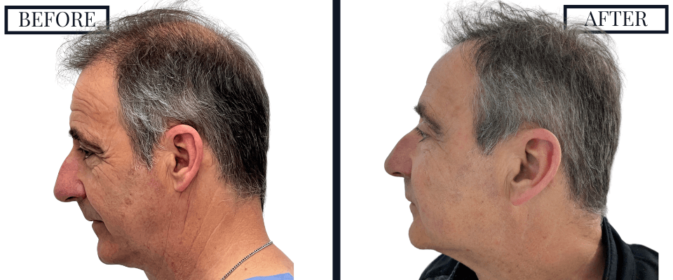 2050 FUE GRAFT HAIR TRANSPLANT