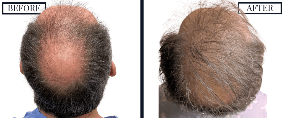 2562 FUE Hair Transplant