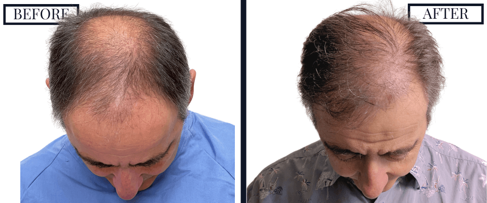 2562 FUE Hair Transplant