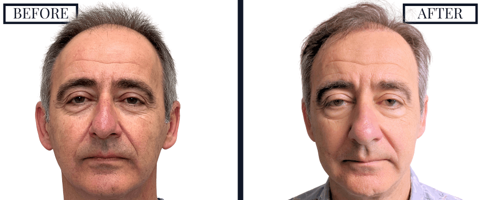 2562 FUE Hair Transplant