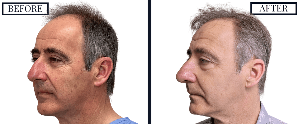 2562 FUE Hair Transplant