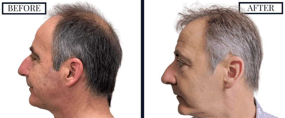 2562 FUE Hair Transplant