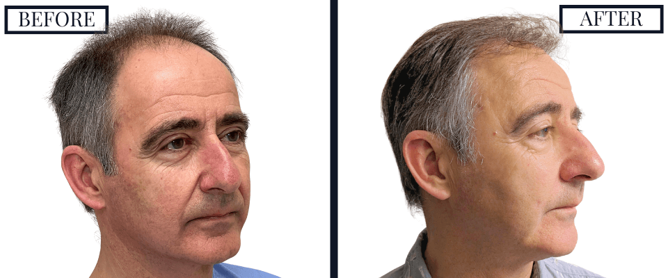2562 FUE Hair Transplant