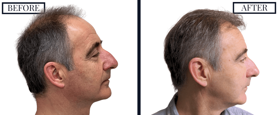 2562 FUE Hair Transplant
