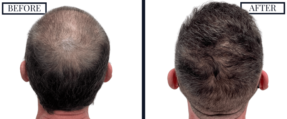 2420 Graft FUE Hair Transplant Before and After