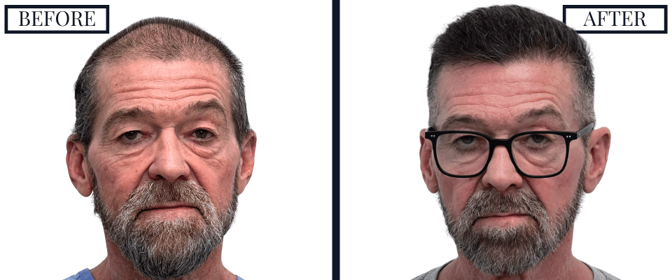 2420 Graft FUE Hair Transplant Before and After