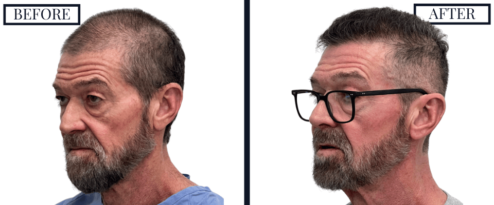 2420 Graft FUE Hair Transplant Before and After