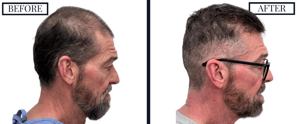 2420 Graft FUE Hair Transplant Before and After