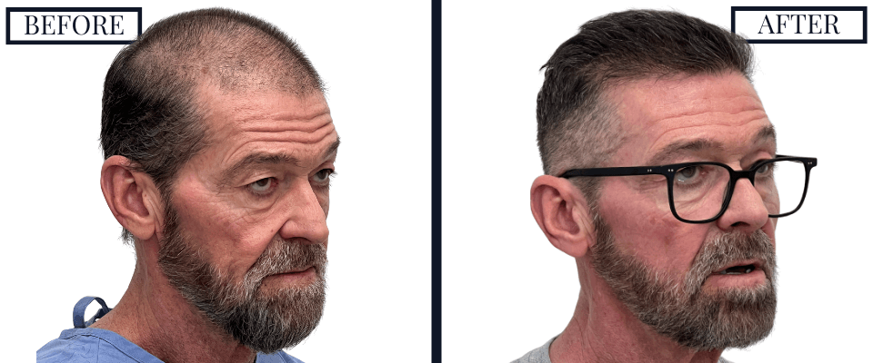 2420 Graft FUE Hair Transplant Before and After